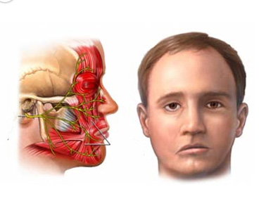 面瘫症状表现图